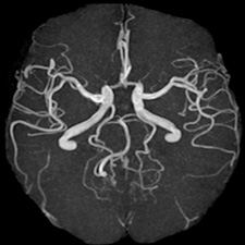 頭部MRA