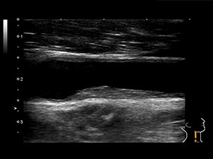 頸部超音波検査